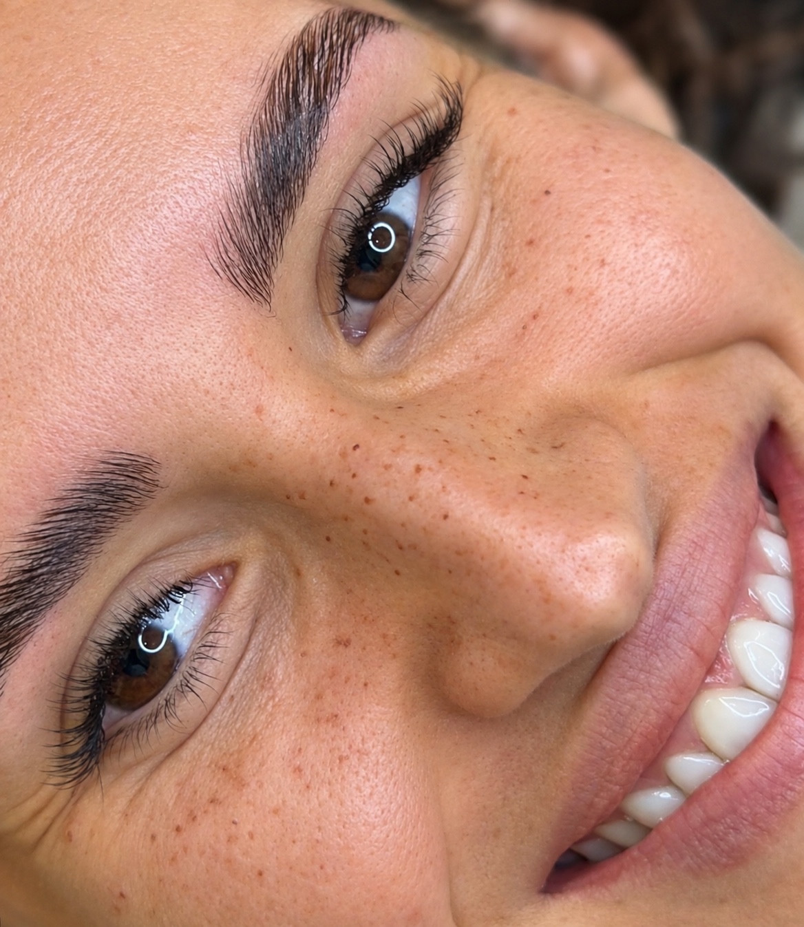Freckles across the cheeks and nose